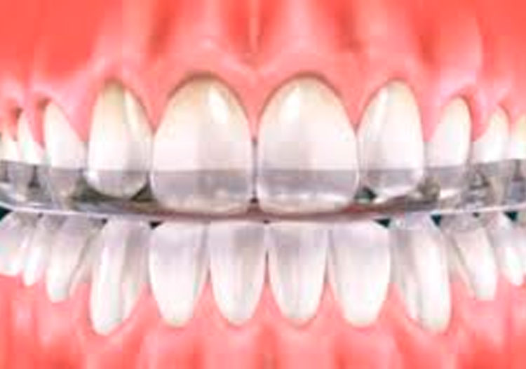 Férulas de descarga, Fisioterapia y ATM - Diagonal Clinic Dental